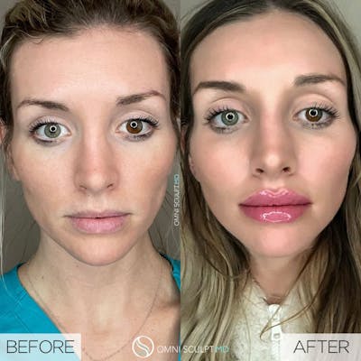 Lips Before & After Gallery - Patient 338604 - Image 1