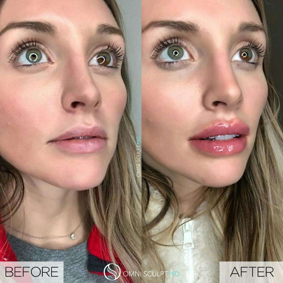 Lips Before & After Gallery - Patient 338604 - Image 3