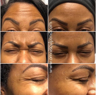 Botox/Neuromodulators Before & After Gallery - Patient 366808 - Image 1