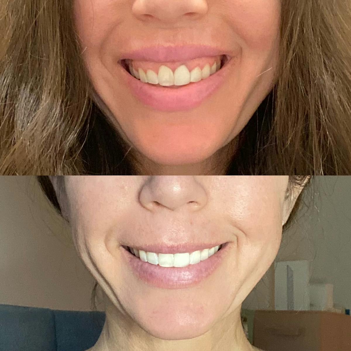 Botox/Neuromodulators Before & After Gallery - Patient 223334 - Image 1