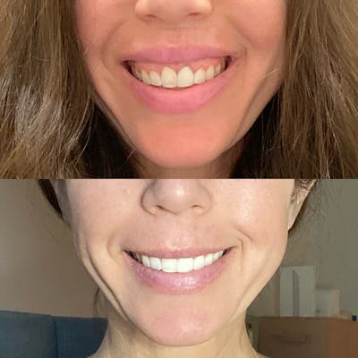 Botox/Neuromodulators Before & After Gallery - Patient 223334 - Image 1