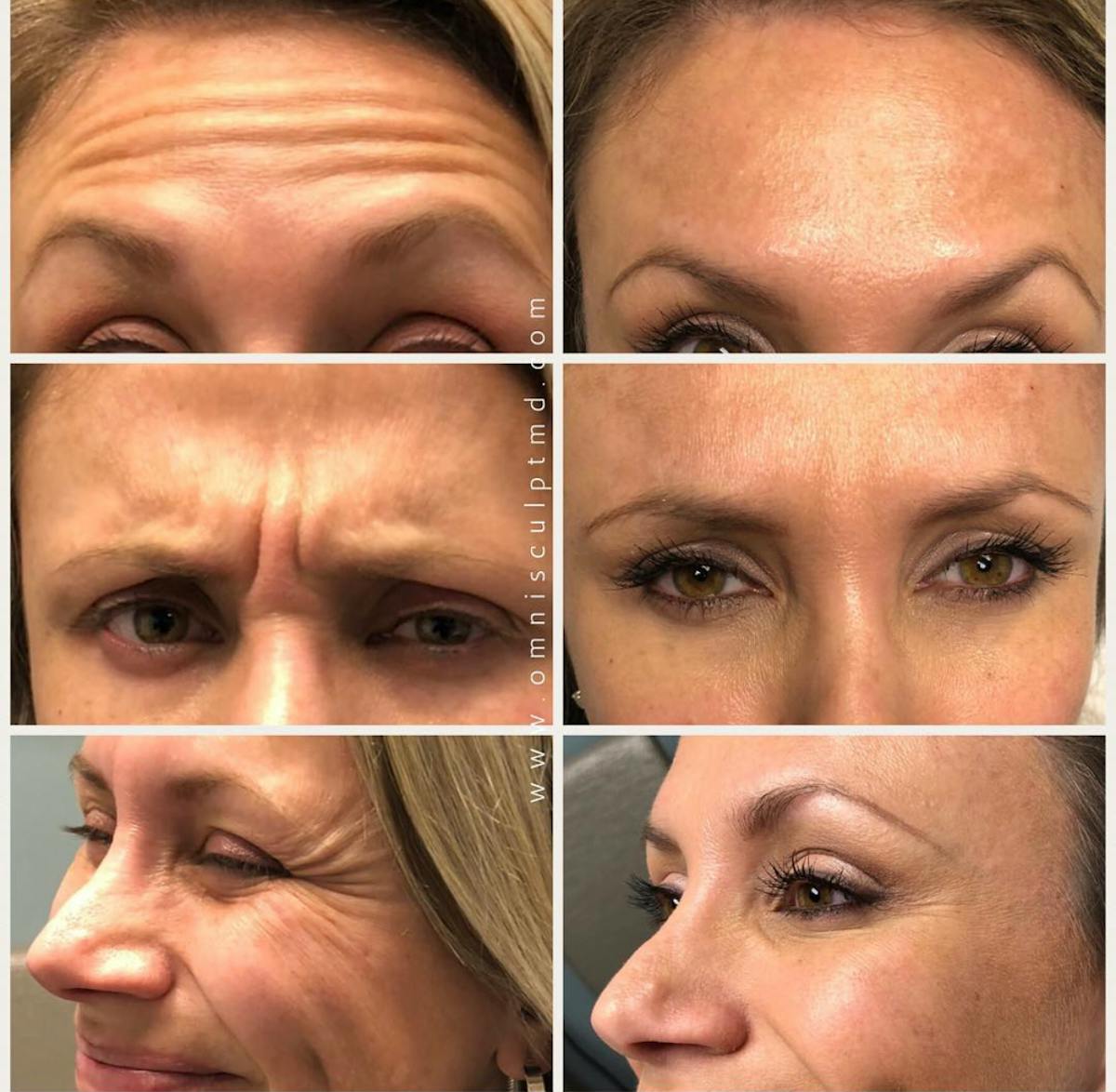 Botox/Neuromodulators Before & After Gallery - Patient 315930 - Image 1