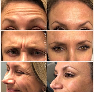 Botox/Neuromodulators Before & After Gallery - Patient 315930 - Image 1