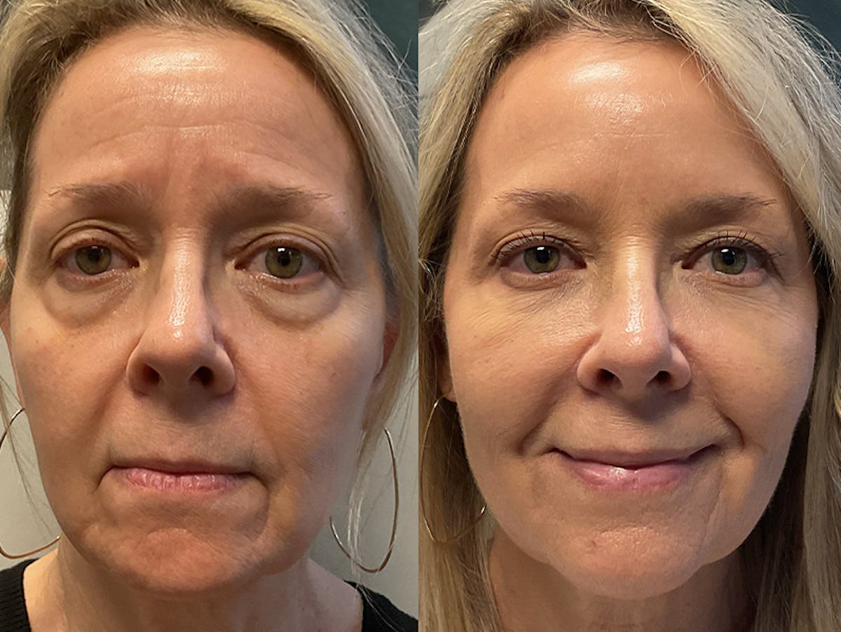 Under Eye & Cheeks Before & After Gallery - Patient 334302 - Image 1