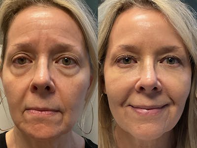 Under Eye & Cheeks Before & After Gallery - Patient 334302 - Image 1
