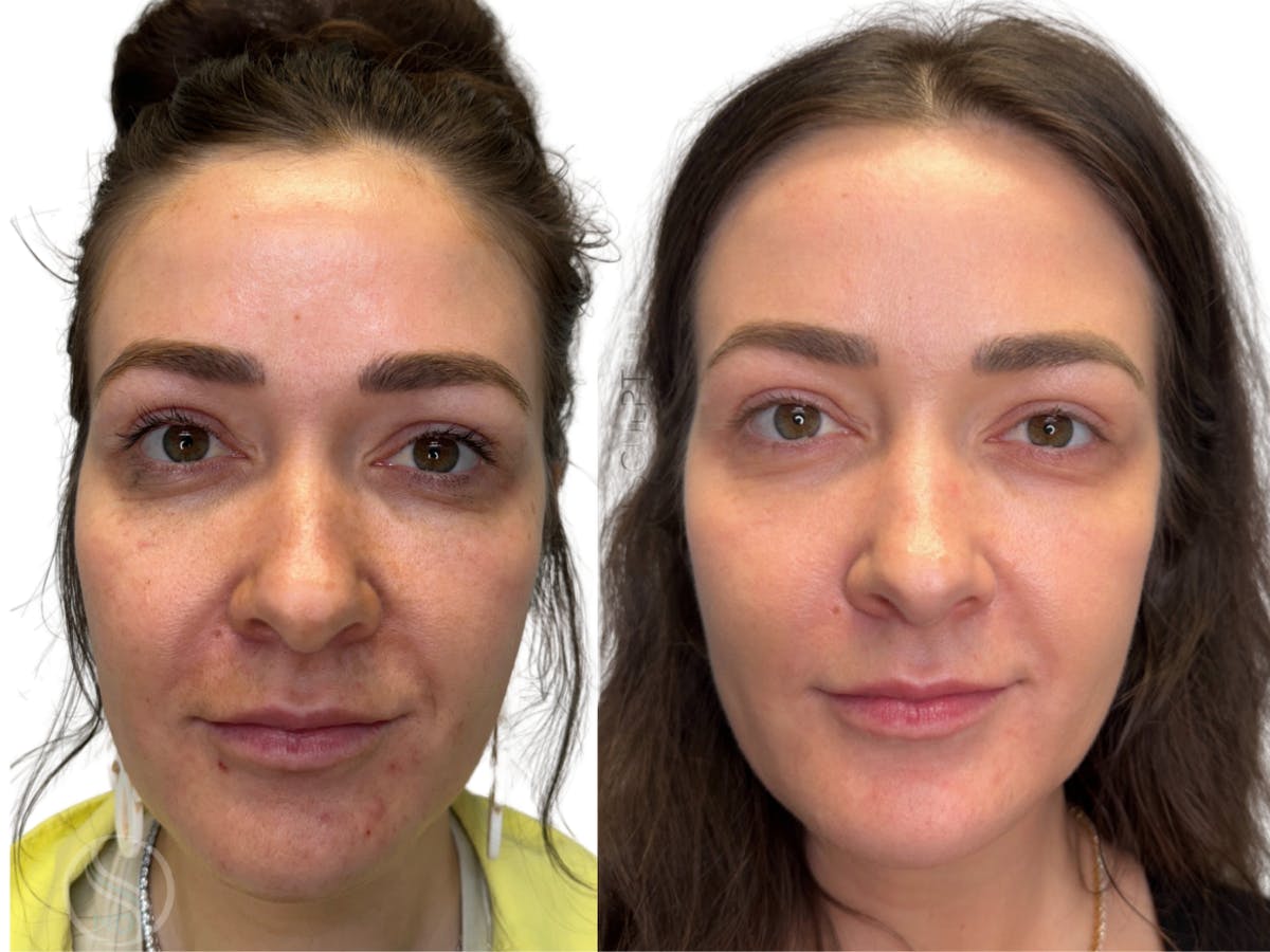 Helix CO2 Laser Before & After Gallery - Patient 113526 - Image 1