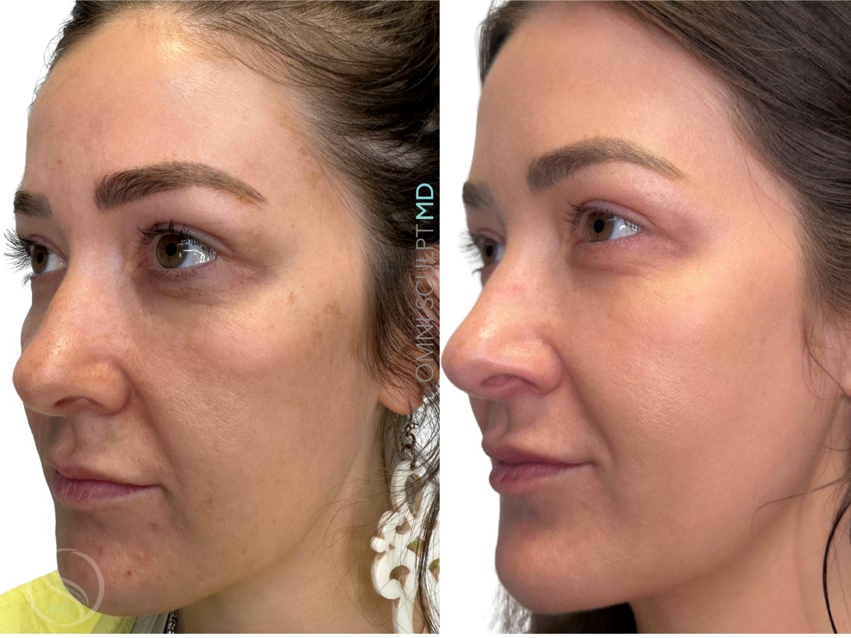 Helix CO2 Laser Before & After Gallery - Patient 113526 - Image 3