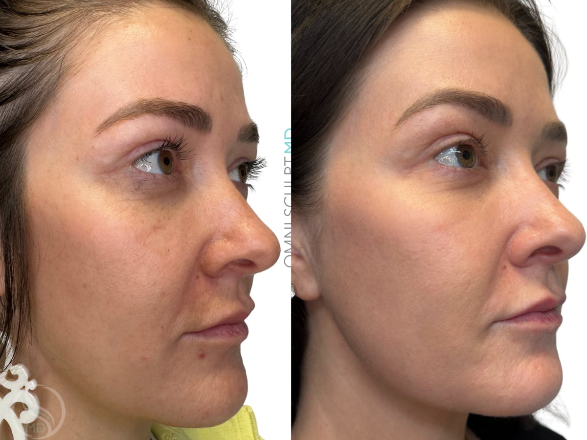 Helix CO2 Laser Before & After Gallery - Patient 113526 - Image 2