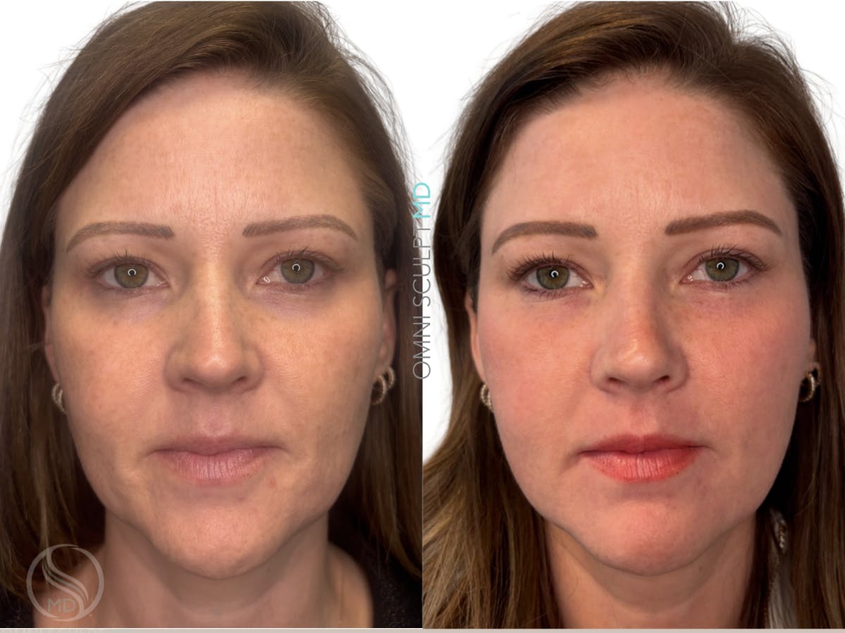 Helix CO2 Laser Before & After Gallery - Patient 130859 - Image 1