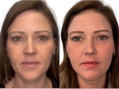 Helix CO2 Laser Before & After Gallery - Patient 130859 - Image 1