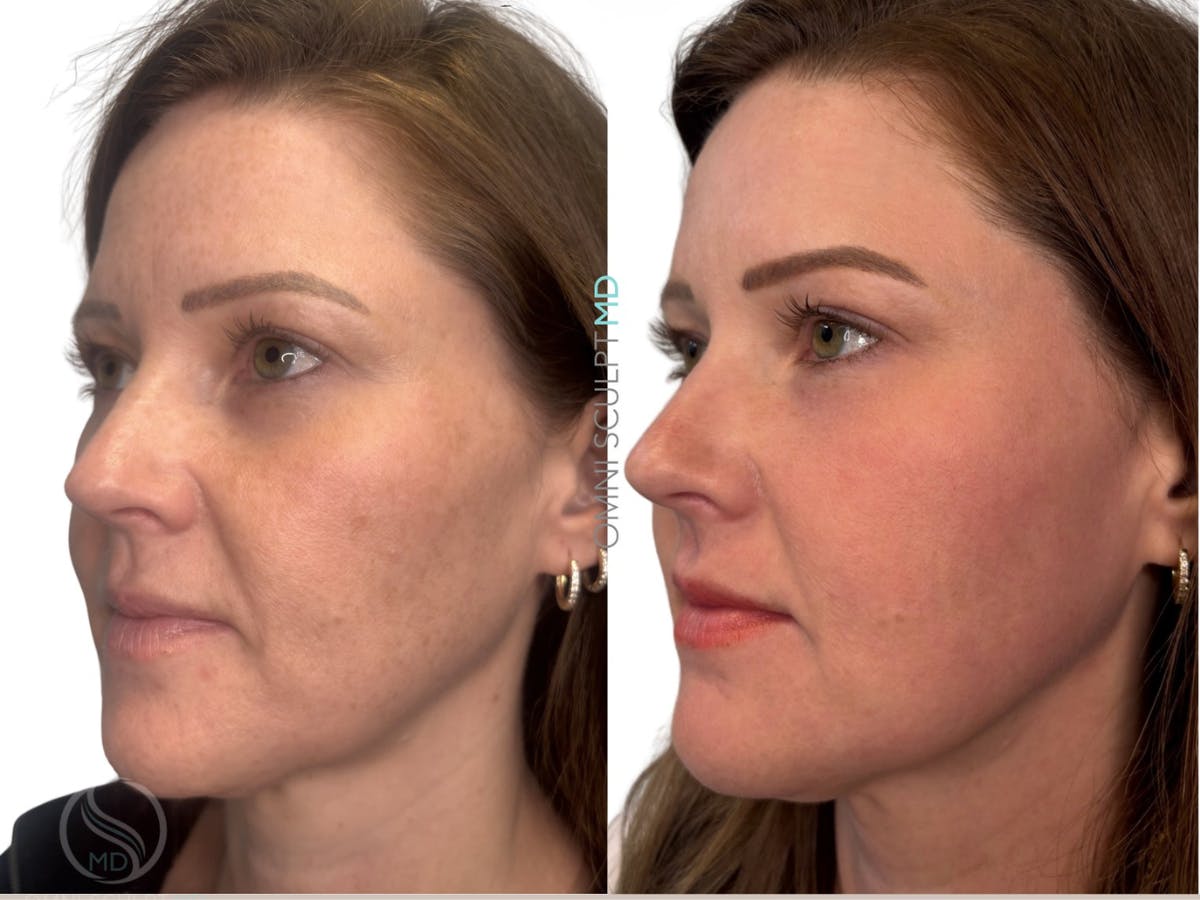Helix CO2 Laser Before & After Gallery - Patient 130859 - Image 2