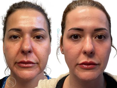 Helix CO2 Laser Before & After Gallery - Patient 705630 - Image 1