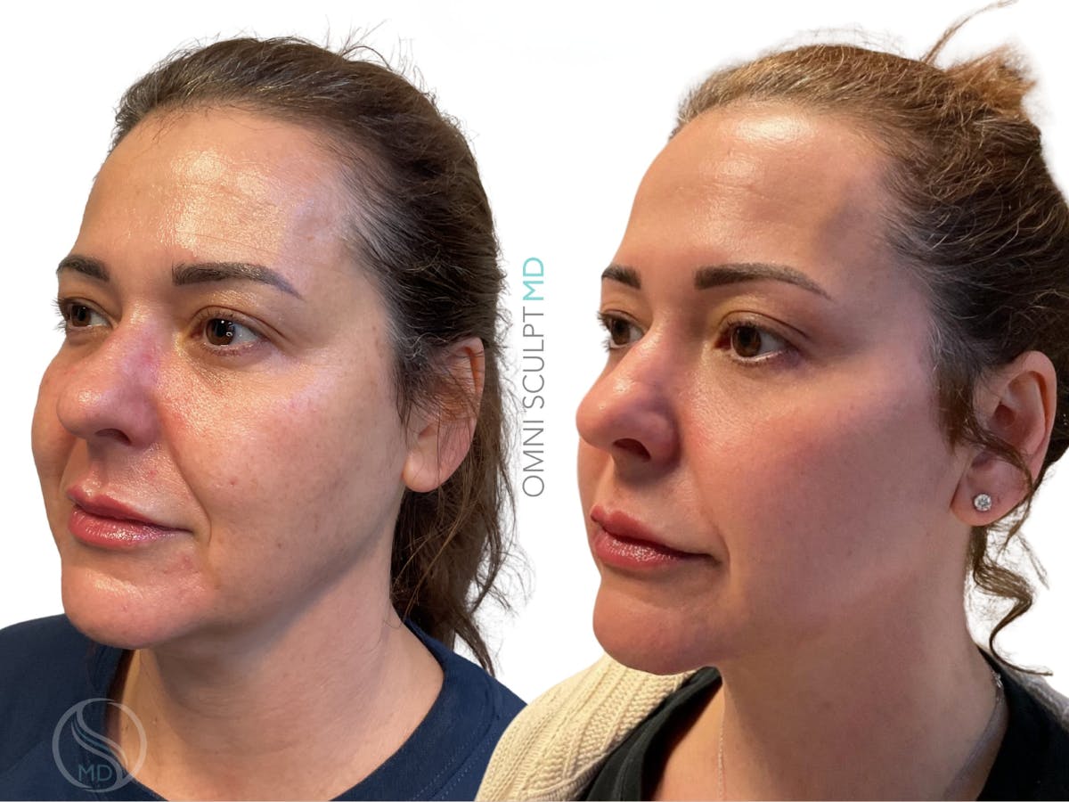 Helix CO2 Laser Before & After Gallery - Patient 705630 - Image 2