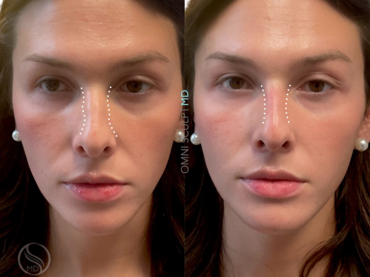 Nose Filler Before & After Gallery - Patient 153627 - Image 1
