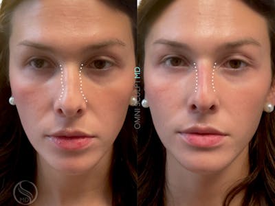 Nose Filler Before & After Gallery - Patient 153627 - Image 1