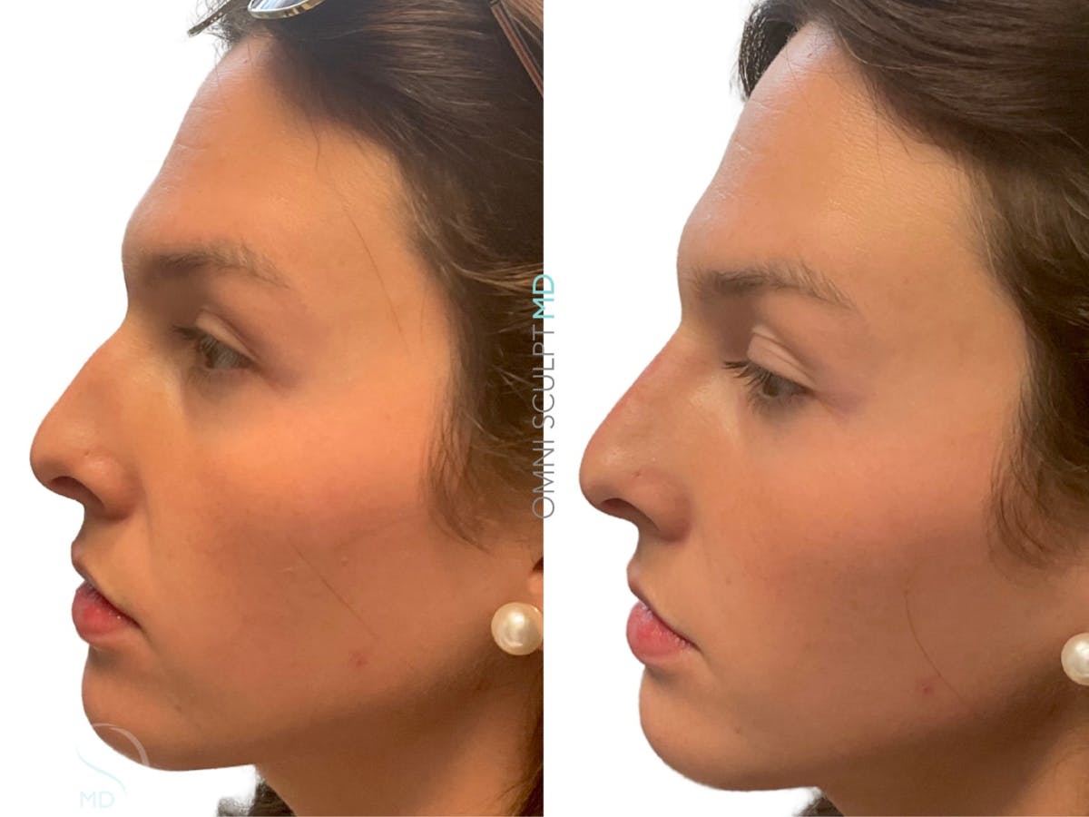 Nose Filler Before & After Gallery - Patient 153627 - Image 3
