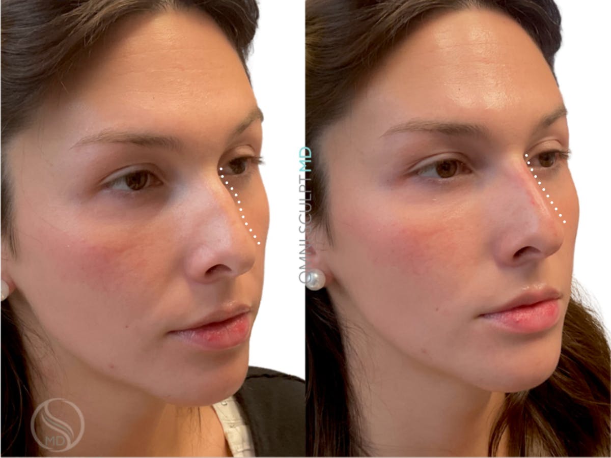 Nose Filler Before & After Gallery - Patient 153627 - Image 2
