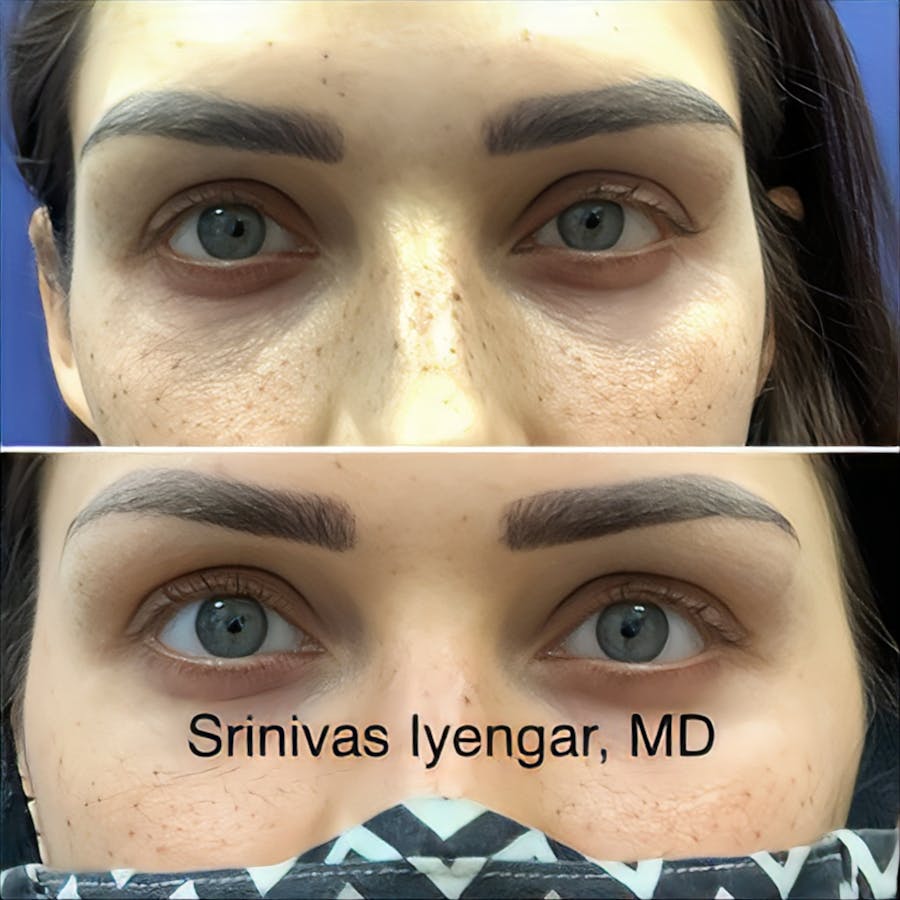 Before and after of Chelsea Clinton