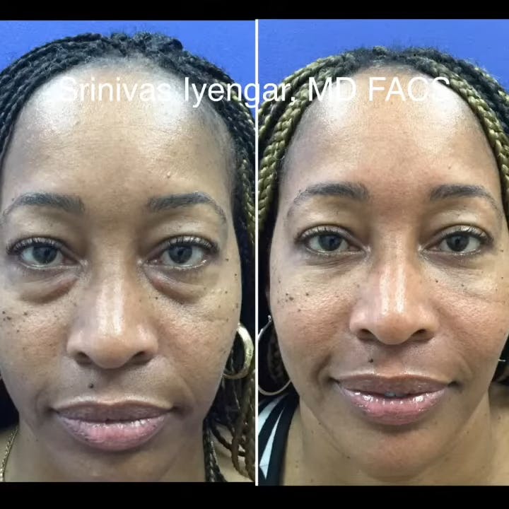 Before and after of a Lower Eyelid Blepharoplasty