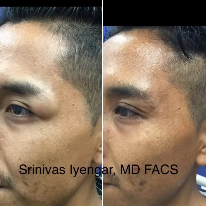 Before and after of an orbital tumor removal