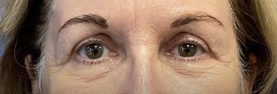 Homepage Gallery Before & After Gallery - Patient 363497 - Image 2