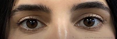 Homepage Gallery Before & After Gallery - Patient 293303 - Image 2