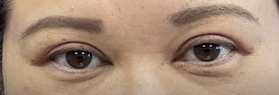 Homepage Gallery Before & After Gallery - Patient 141382 - Image 2