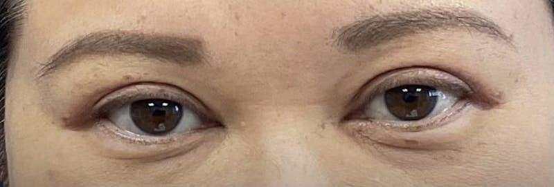 Homepage Gallery Before & After Gallery - Patient 141382 - Image 2