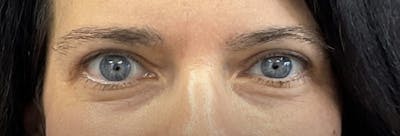 Homepage Gallery Before & After Gallery - Patient 192168 - Image 2