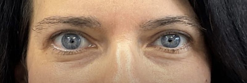 Homepage Gallery Before & After Gallery - Patient 192168 - Image 2