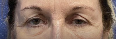 Homepage Gallery Before & After Gallery - Patient 363497 - Image 1