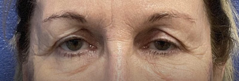 Homepage Gallery Before & After Gallery - Patient 363497 - Image 1