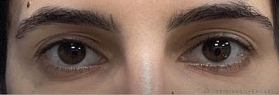 Homepage Gallery Before & After Gallery - Patient 293303 - Image 1