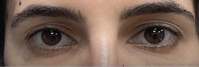 Homepage Gallery Before & After Gallery - Patient 293303 - Image 1