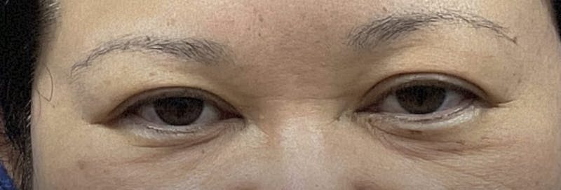 Homepage Gallery Before & After Gallery - Patient 141382 - Image 1