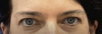 Homepage Gallery Before & After Gallery - Patient 192168 - Image 1