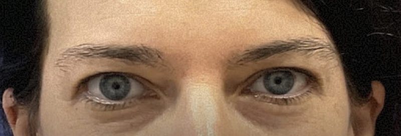 Homepage Gallery Before & After Gallery - Patient 192168 - Image 1