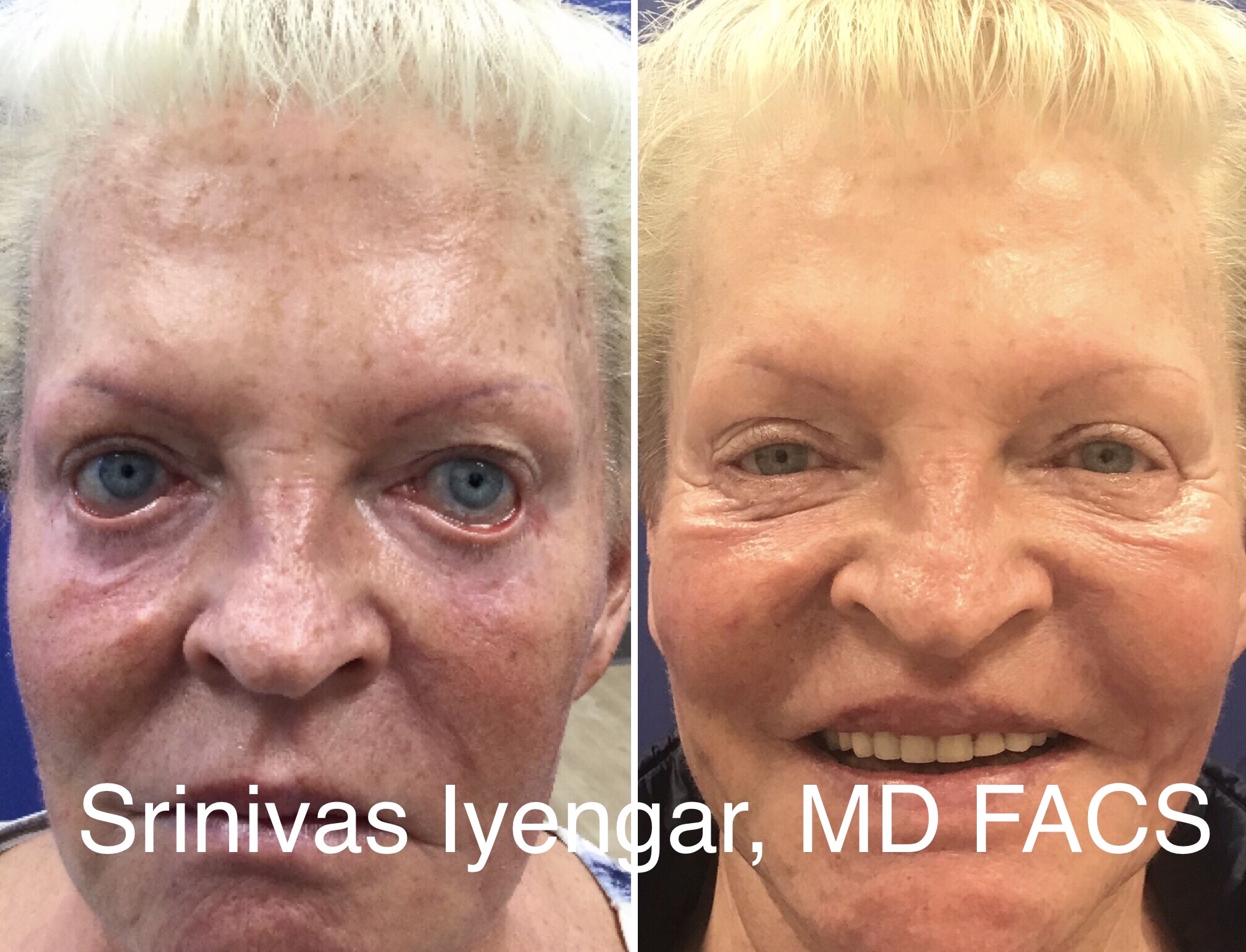 San Diego Eyelid Specialists Blog | What Are Common Types Of Eyelid Surgery?