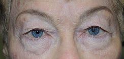 San Diego Eyelid Specialists Blog | Droopy Eyelids And Insurance