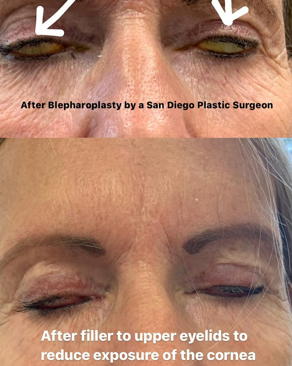 Plastic Surgeon Bleph