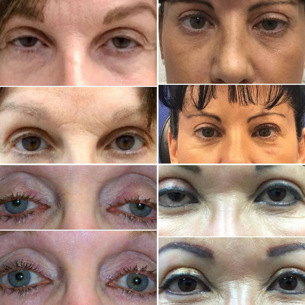 Fixing Botched Eyelid Surgery Botched Eyelid Surgery