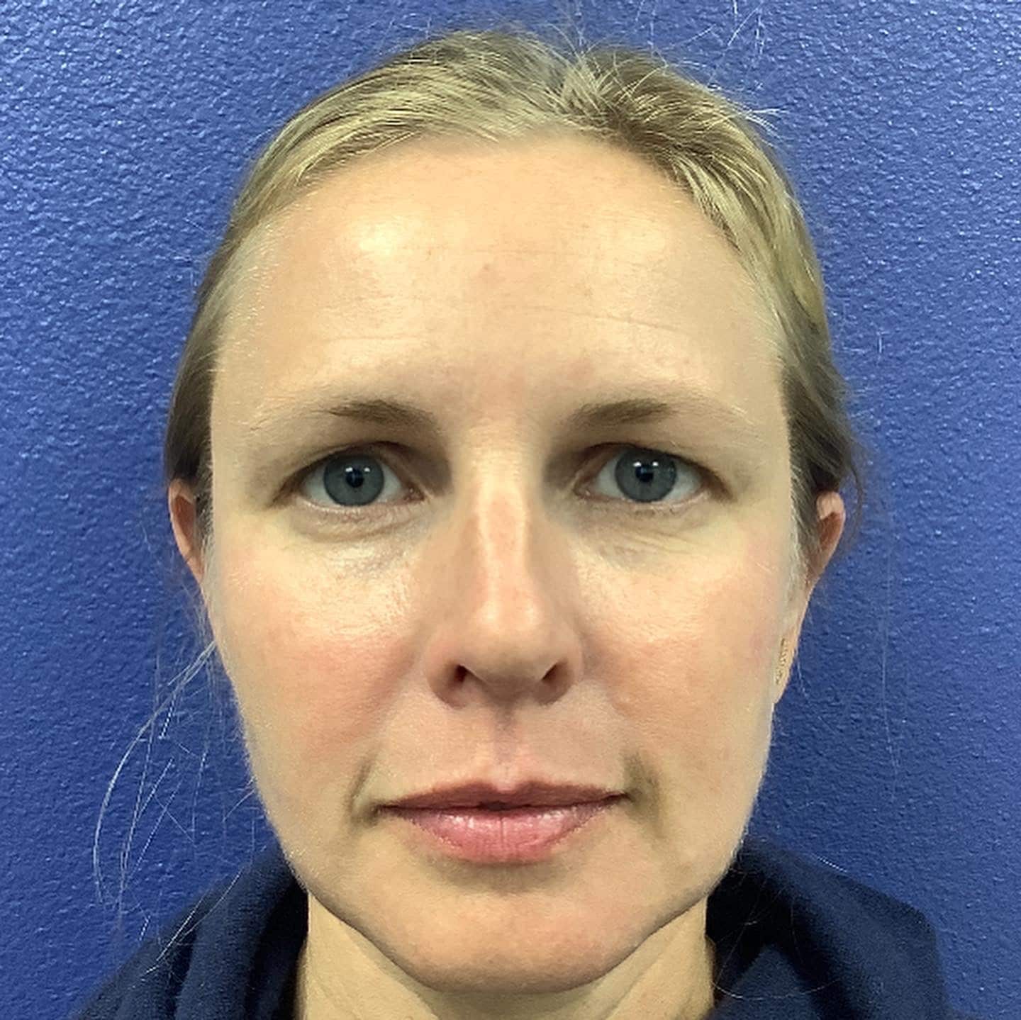 Upper Blepharoplasty Before And Afters