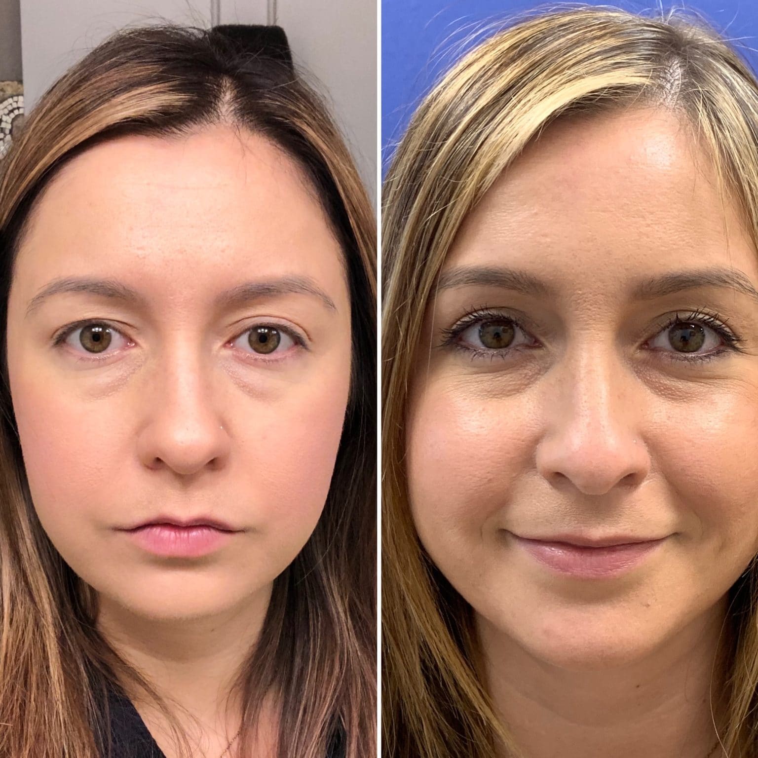 Upper Blepharoplasty Case Results