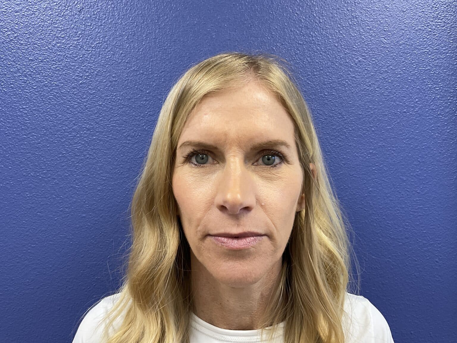 Upper Blepharoplasty Case Results