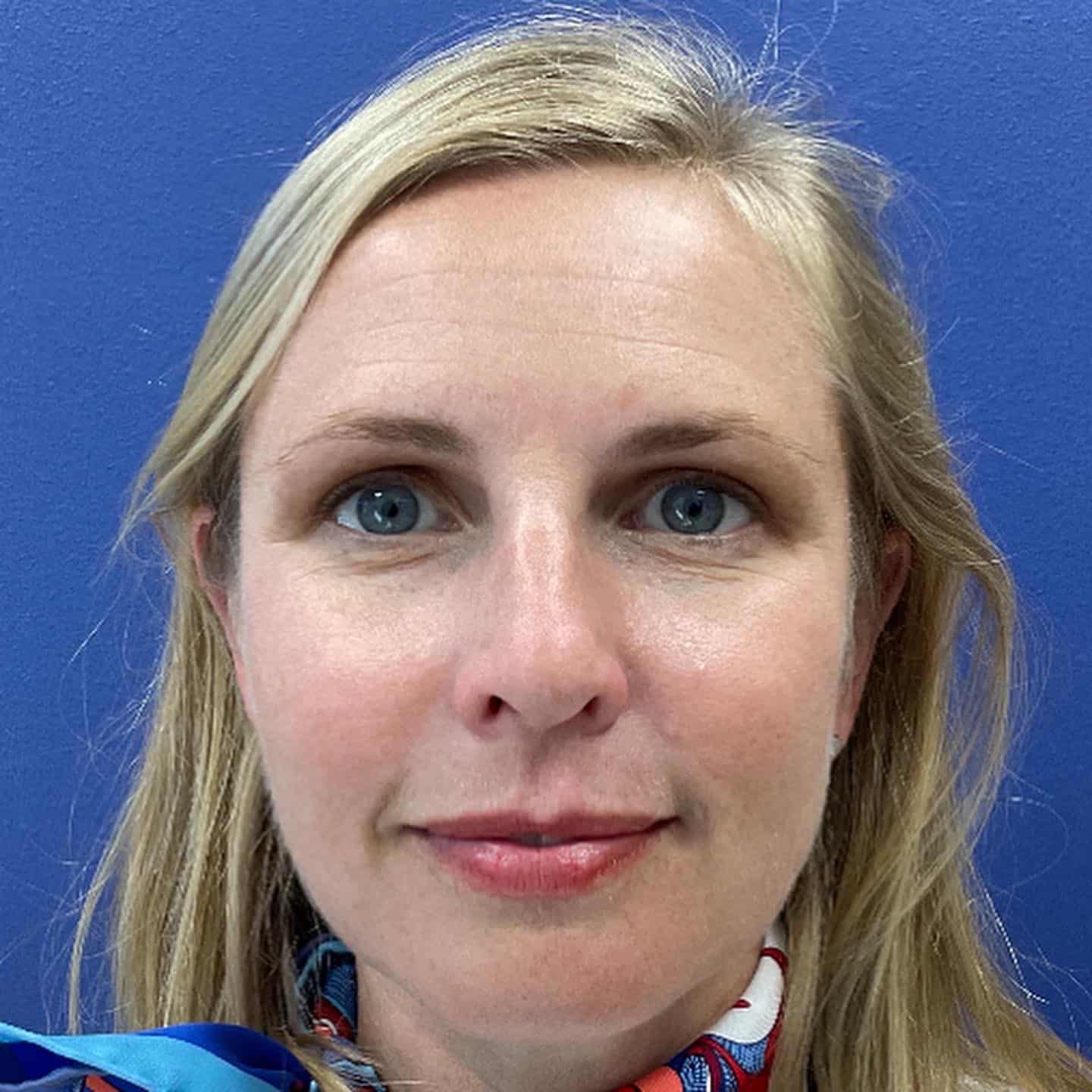 Upper Blepharoplasty Case Results