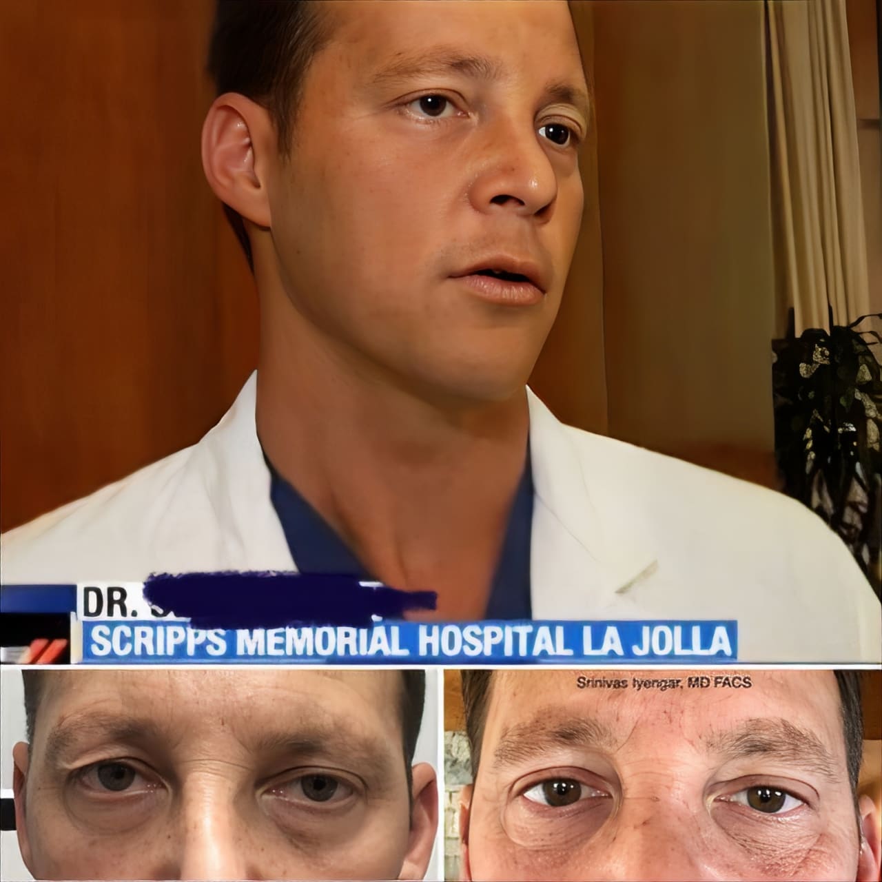 Upper Blepharoplasty Case Results