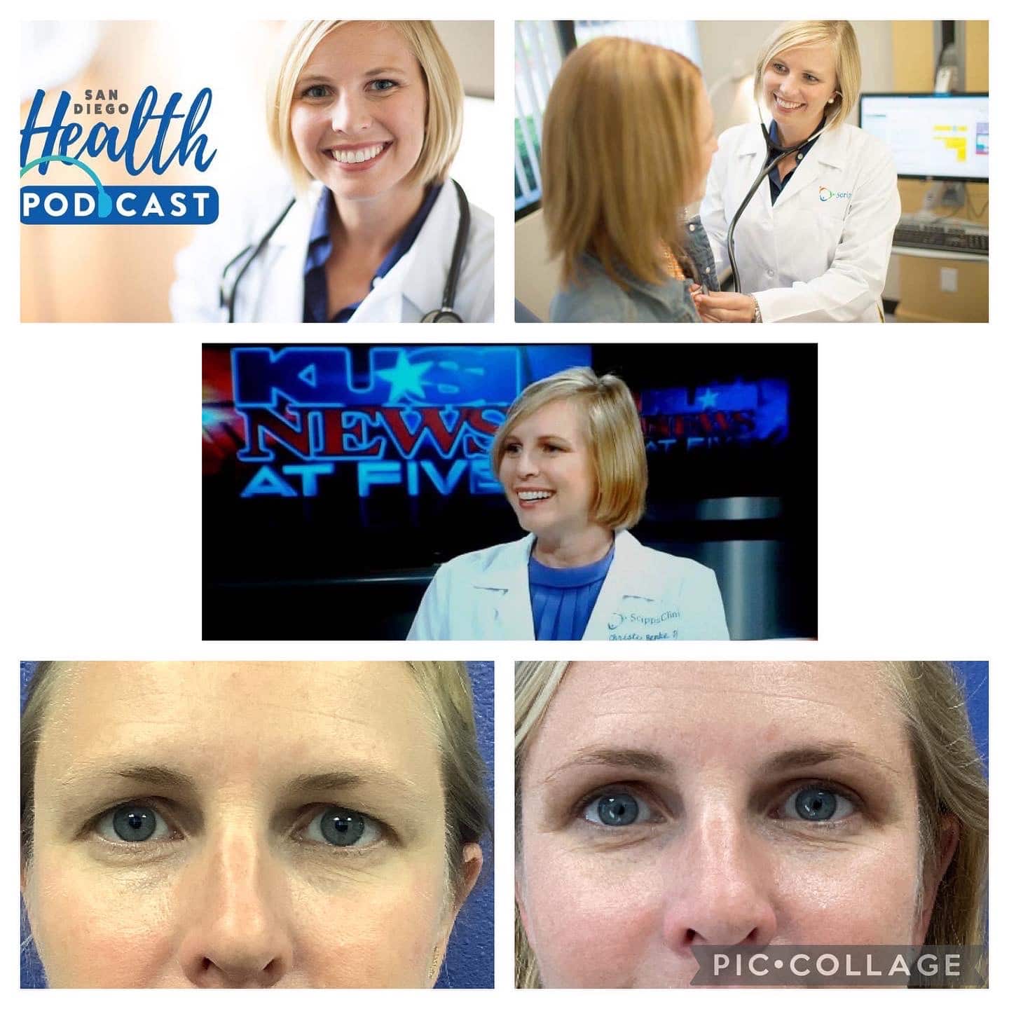 Upper Blepharoplasty Case Results