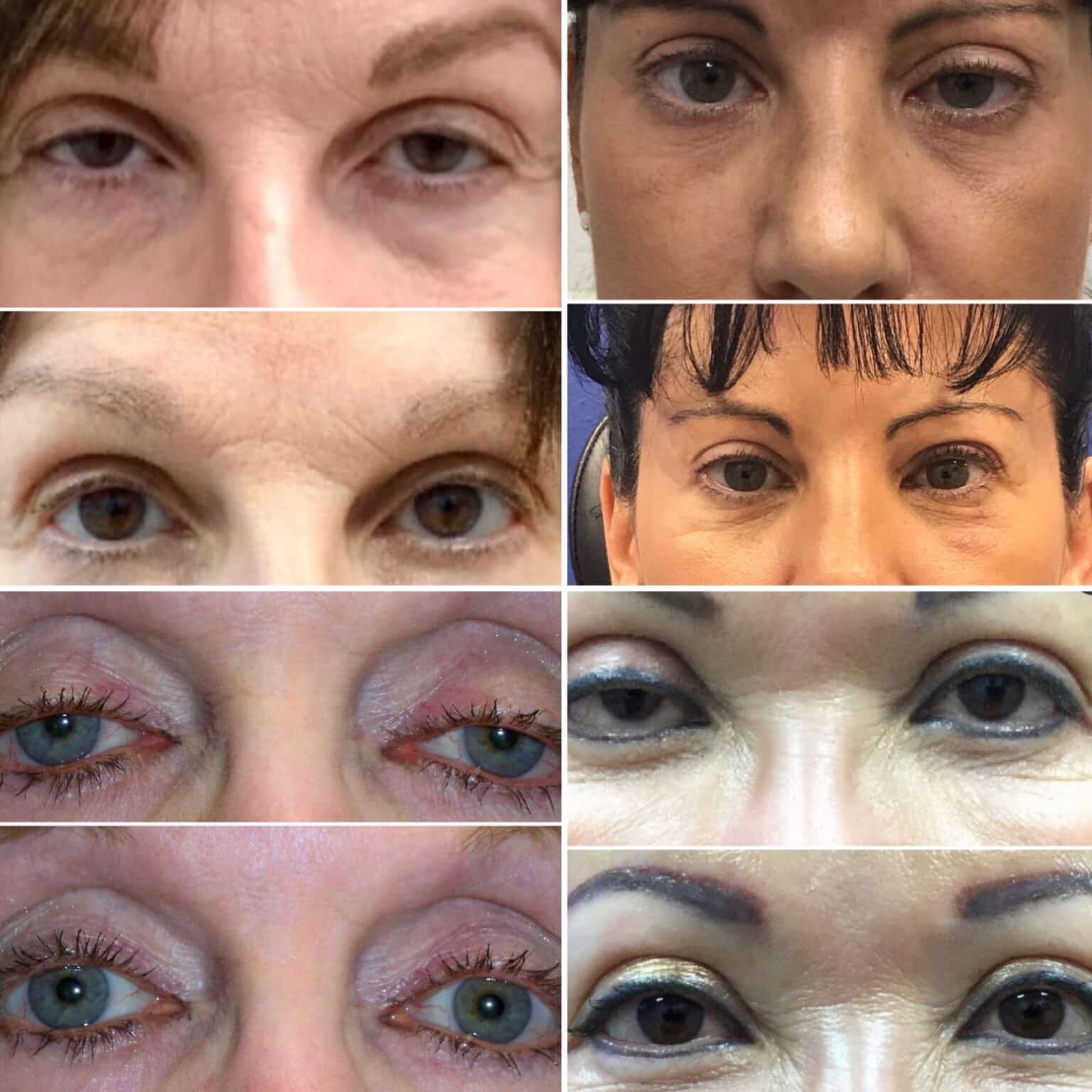 Upper Blepharoplasty Case Results