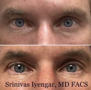 Upper Blepharoplasty Case Results