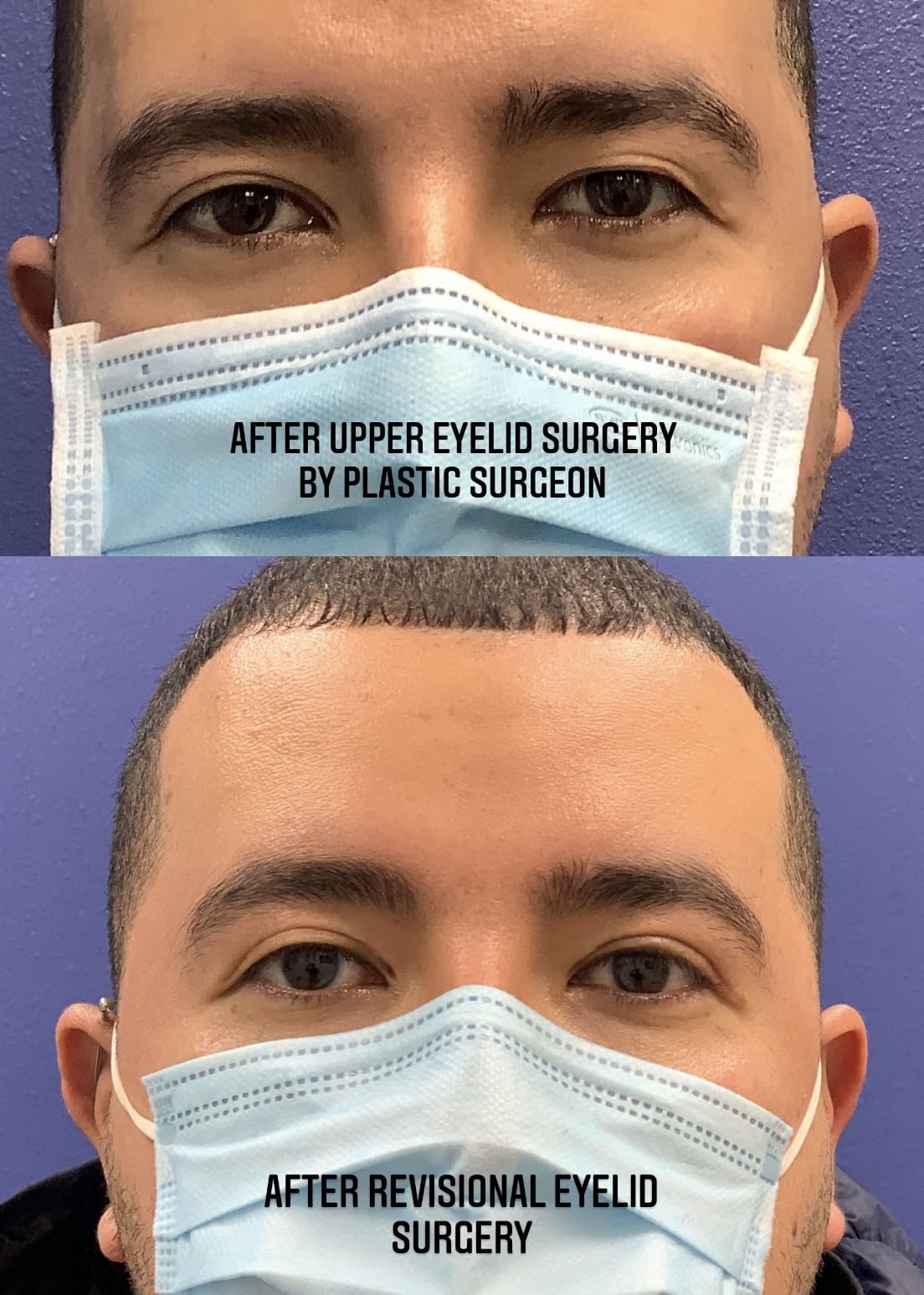 Upper Blepharoplasty Case Results